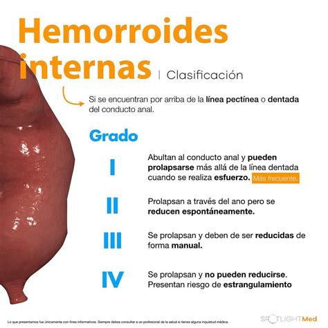 fotos reales de hemorroides|Fotos de Hemorroides